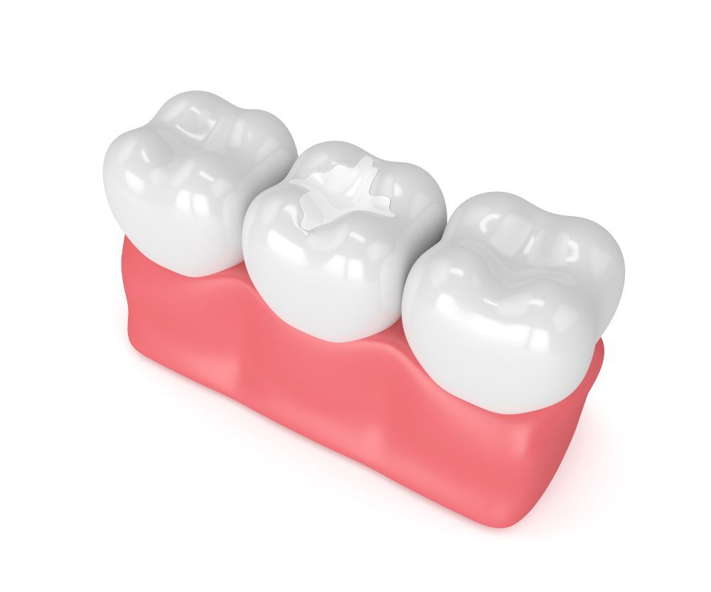 composite dental fillings Babylon New York 