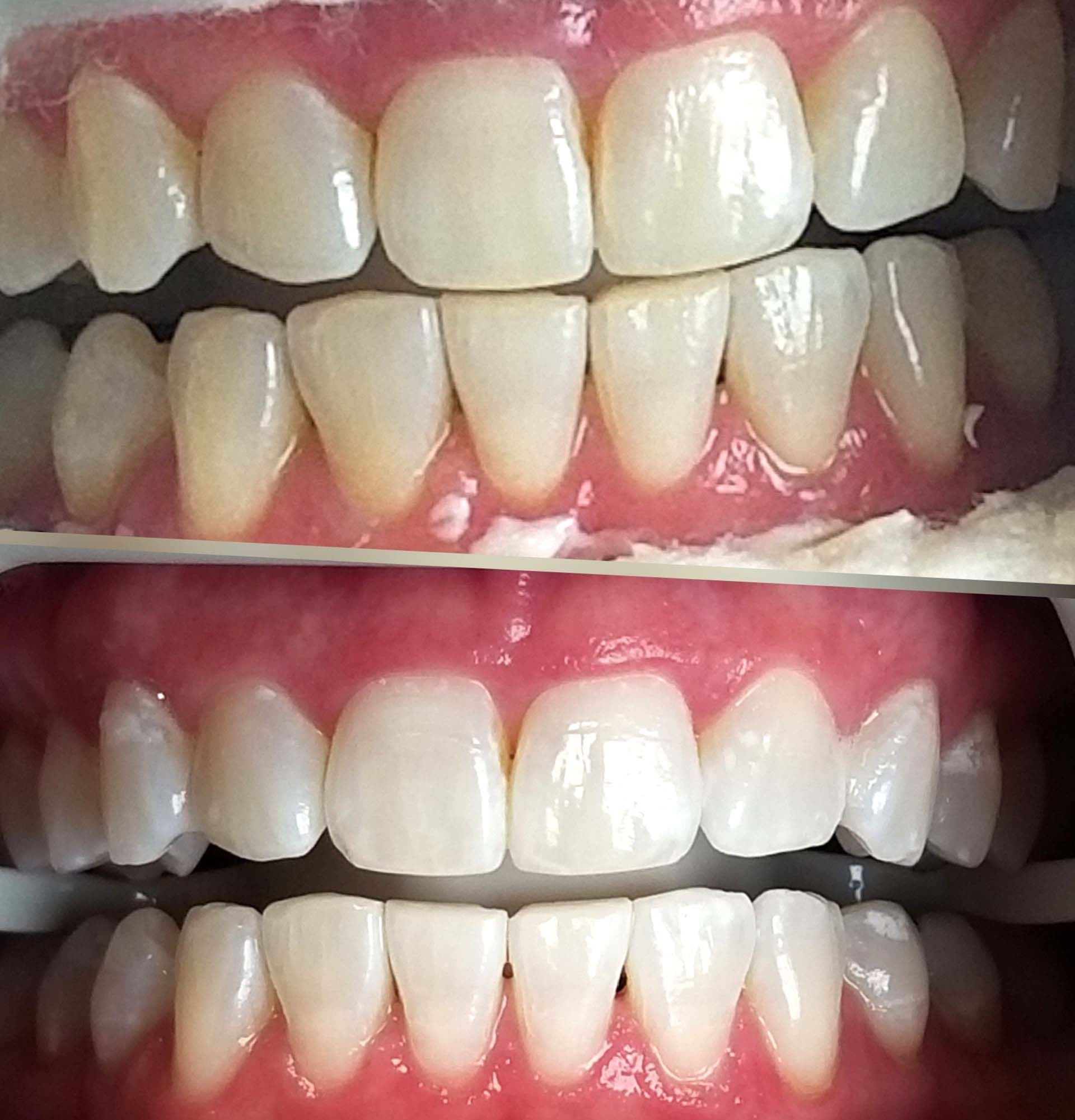 Zoom Whitening Babylon, New York.- Dr Colleen L Catera DMD