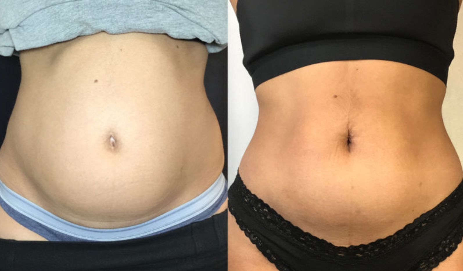 Before and after photos of a woman's abdomen: increased muscle definition and reduced fat.