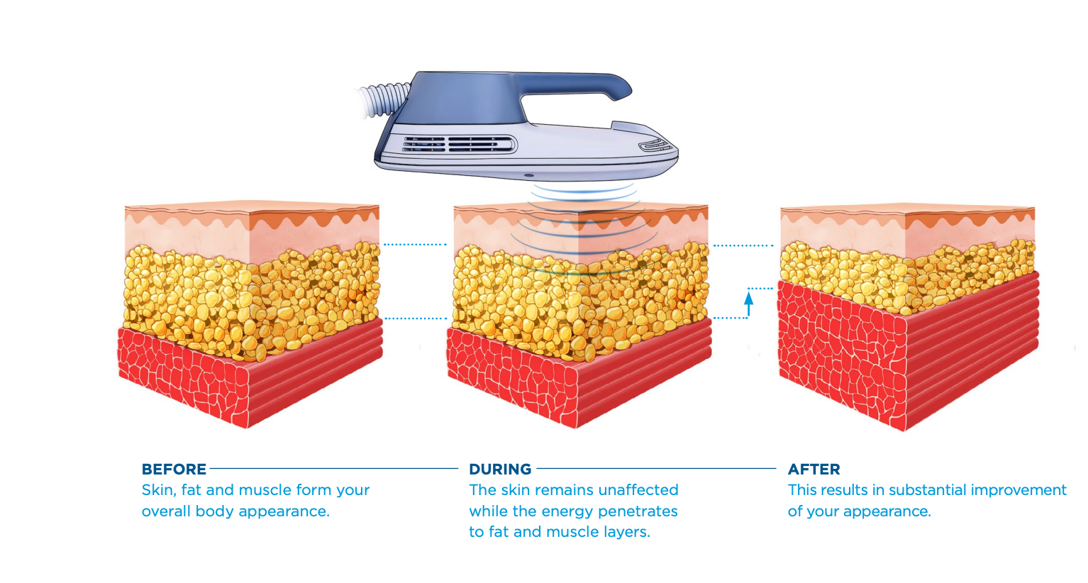 Diagram: Skin layers before, during, and after treatment with a device, improving skin appearance.