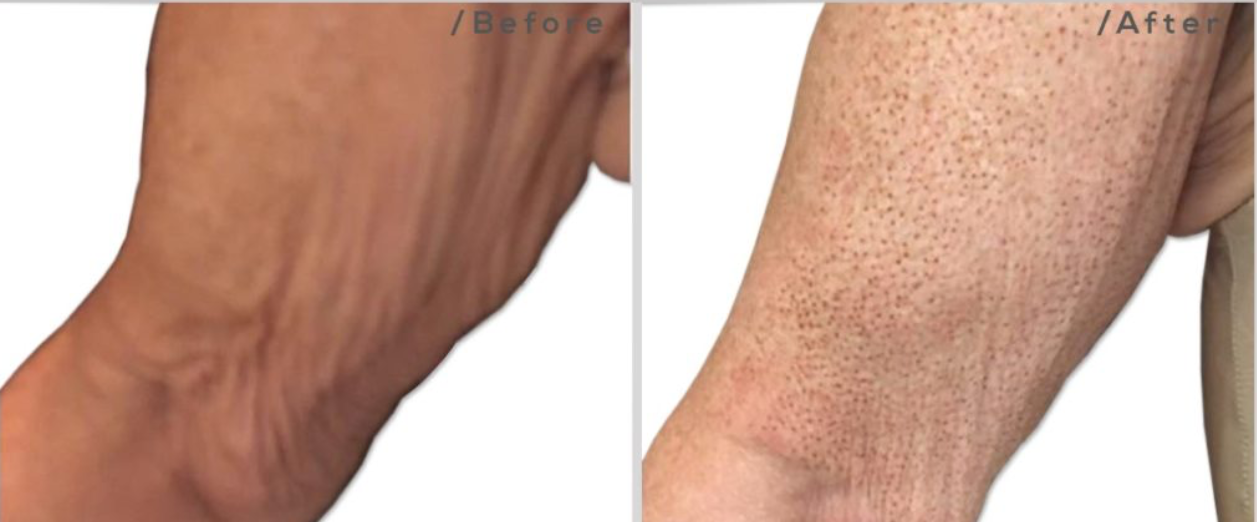 Before and after of arm skin showing skin tightening.