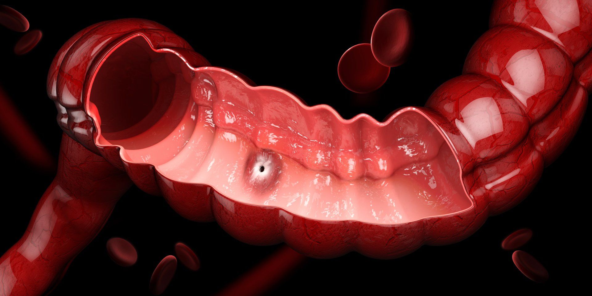 A computer generated image of a cross section of an intestine with an ulcer.