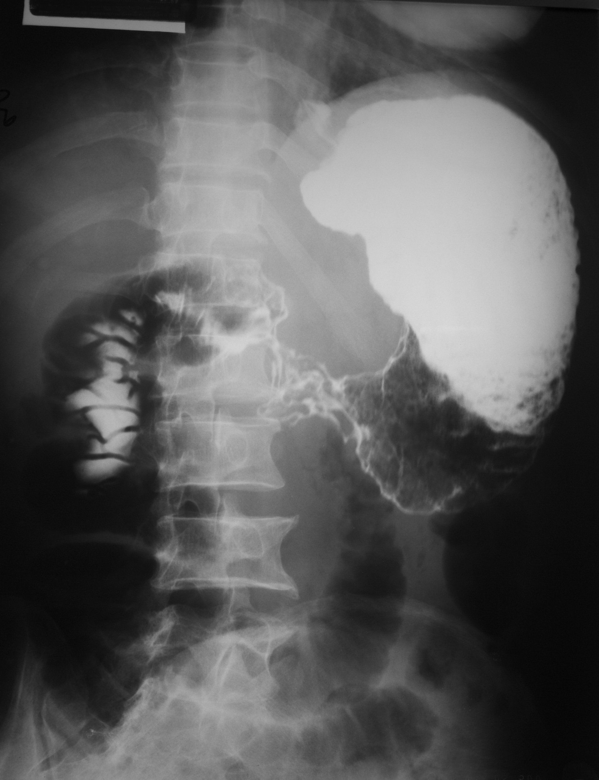 Upper Gastro Study - UGI