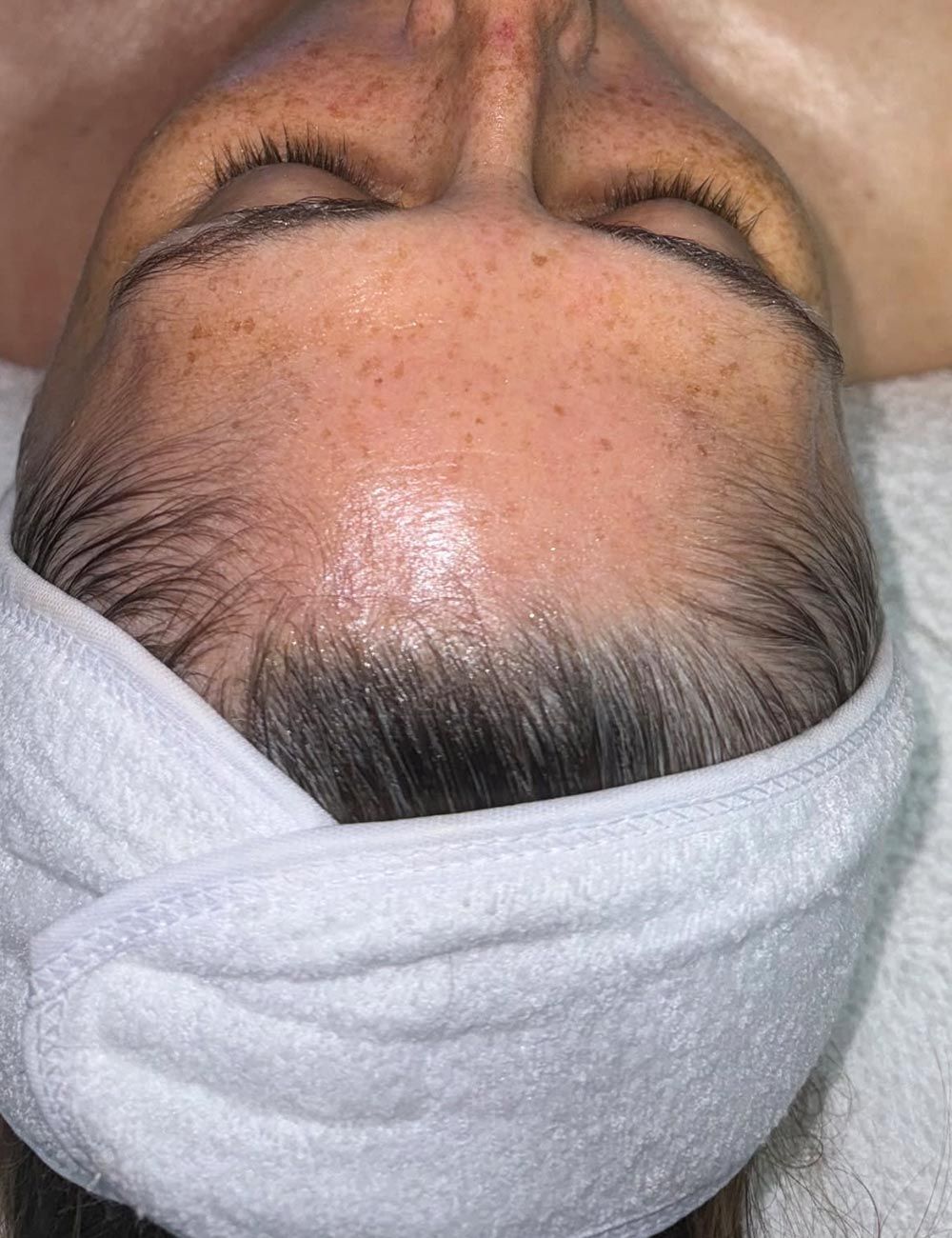 Close-up of a person's forehead with visible freckles, wrapped in a white towel.