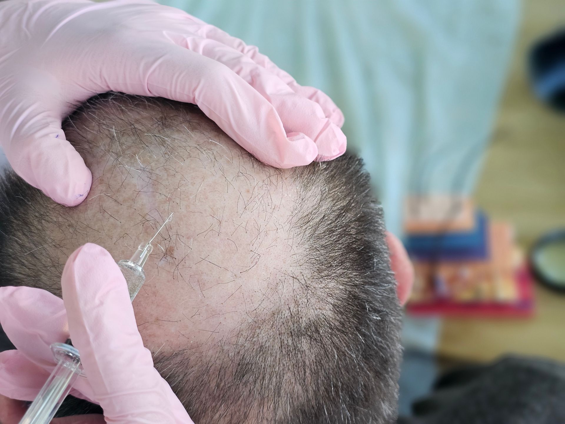 Gloved hands injecting a bald scalp with a syringe in a clinical setting