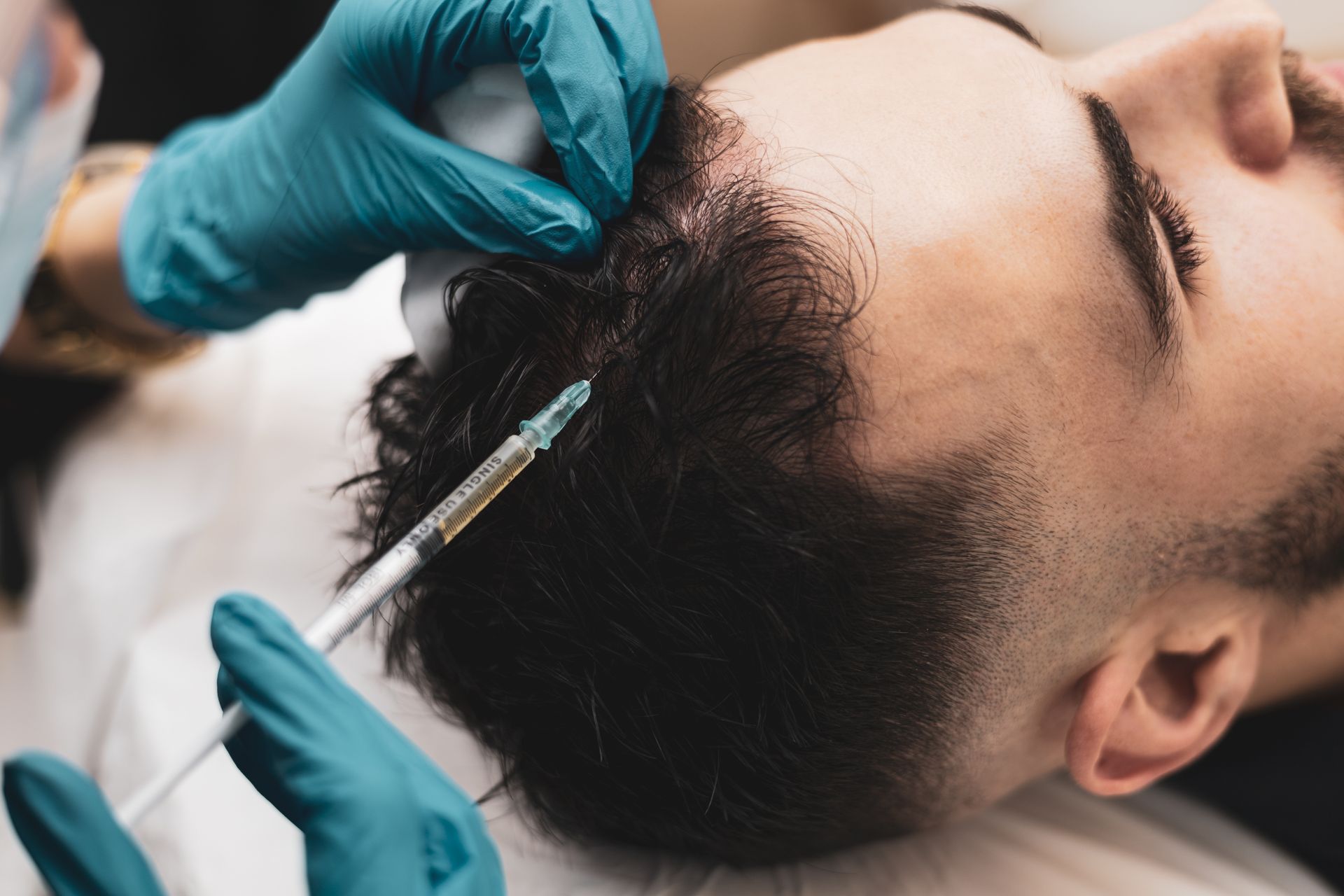 Gloved hands injecting a bearded man's scalp during a hair restoration procedure Gloved hands injecting a bearded man's scalp during a hair restoration procedure