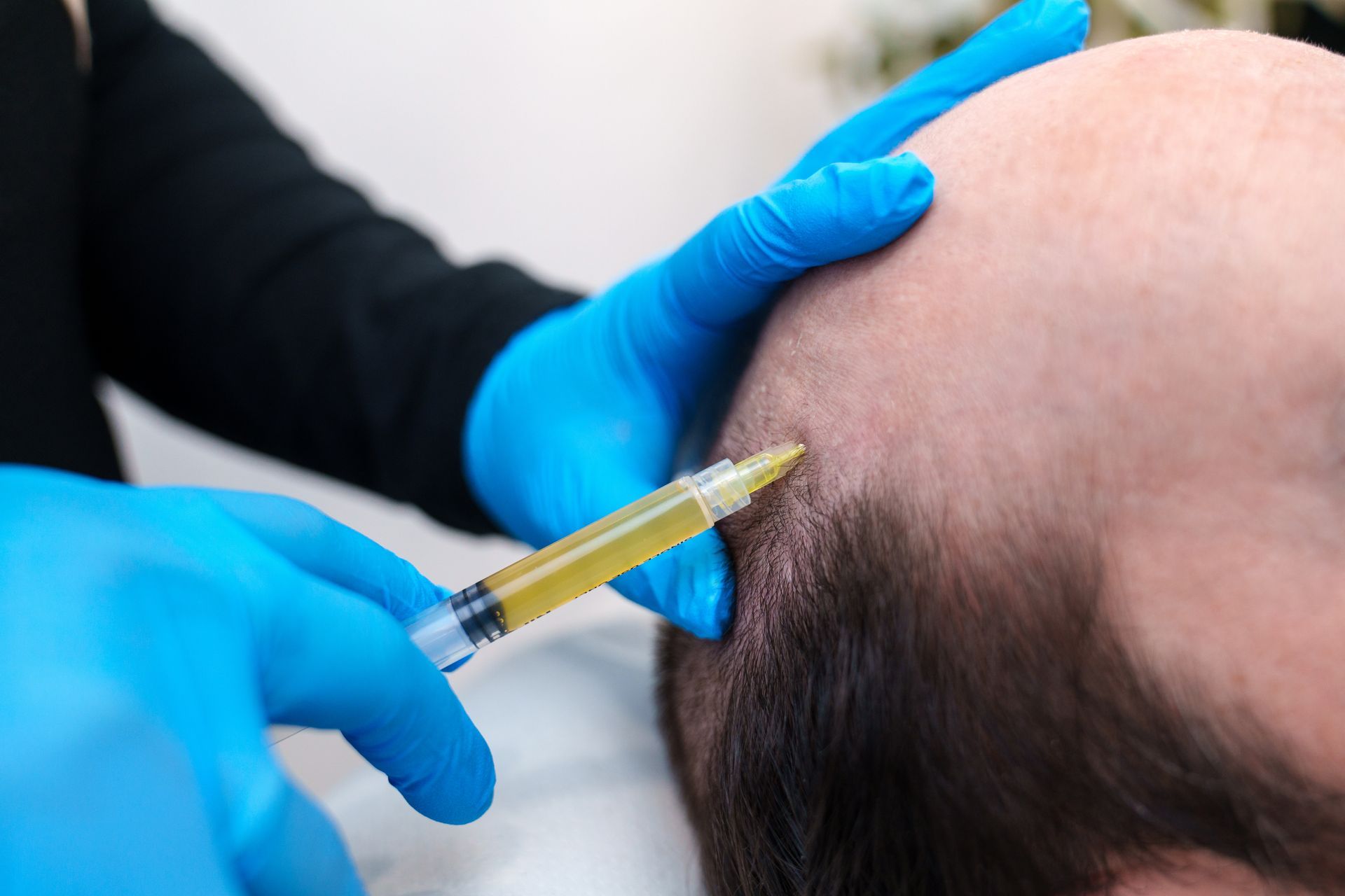 Gloved hands inject a syringe into a bald scalp, suggesting a medical procedure Gloved hands inject a syringe into a bald scalp, suggesting a medical procedure