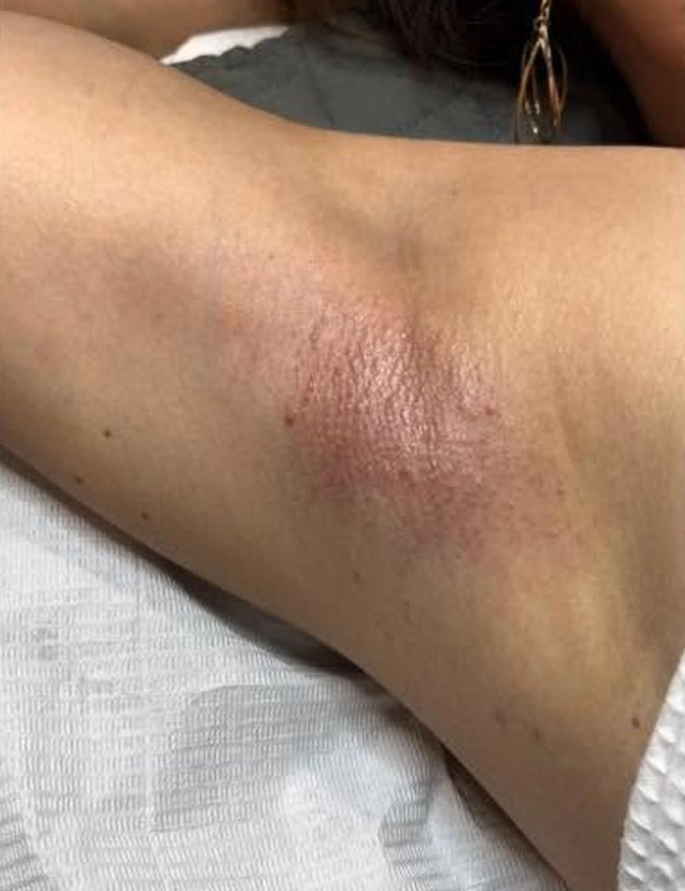 Close-up of a bent arm with a reddish, dry patch near the elbow crease on a white fabric background
