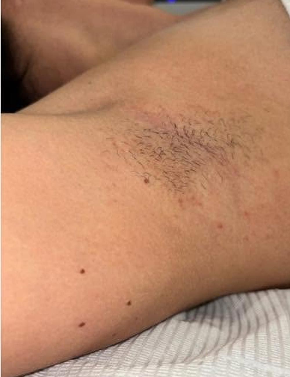 Close-up of a bare upper thigh with a dark bruise near the hip.
