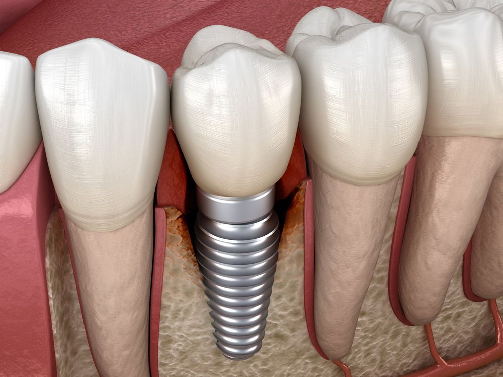 impianti dentali