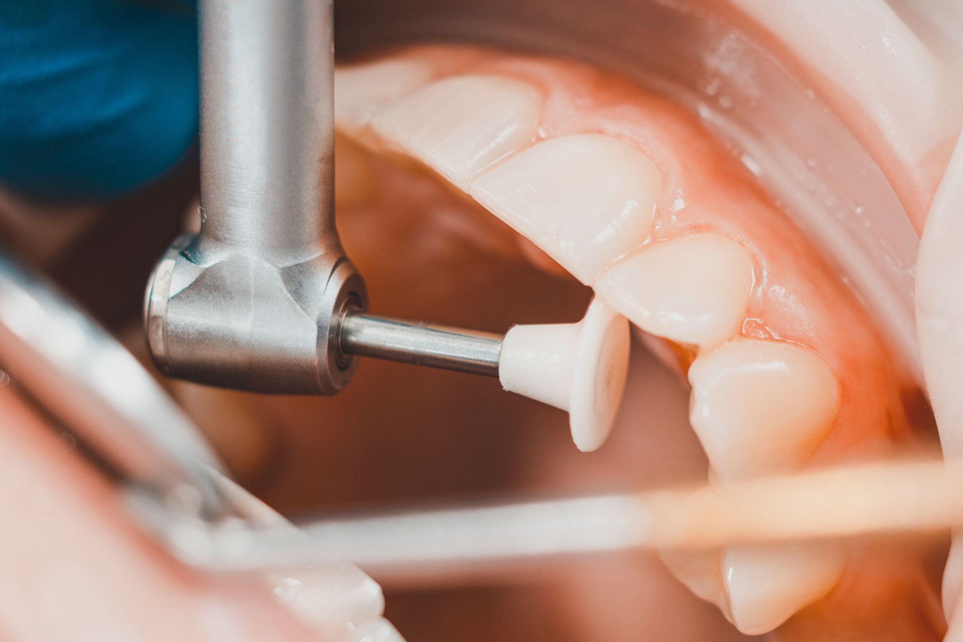Dentist uses a curing light on a patient's teeth. The patient is in a dental chair with mouth open.