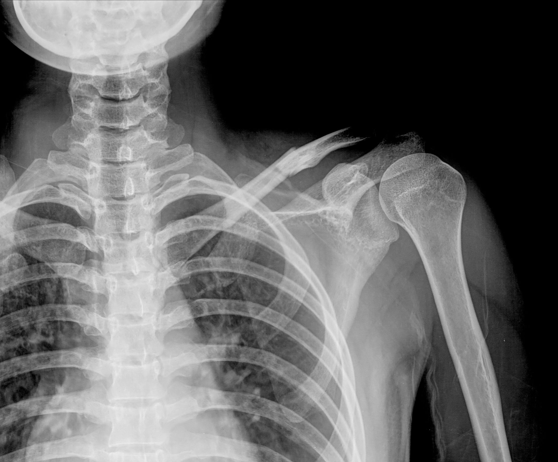 Una radiografía del esqueleto de una persona que muestra las costillas y el hombro.