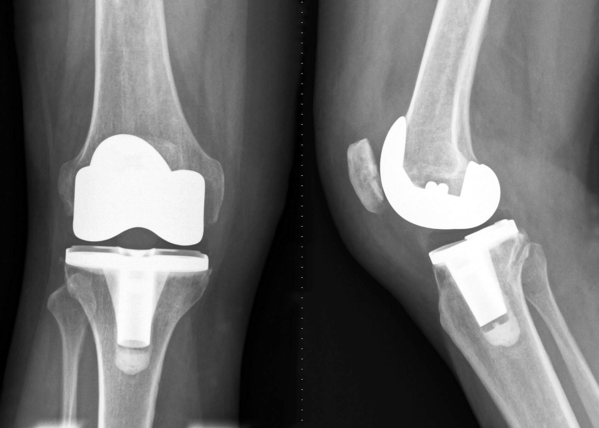 Una radiografía de una rodilla con una prótesis de rodilla