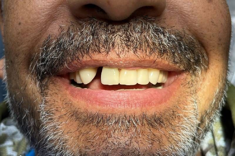A man with a beard and missing teeth is smiling.