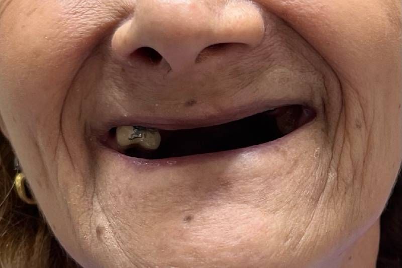 A close up of an elderly woman 's mouth with a missing tooth.