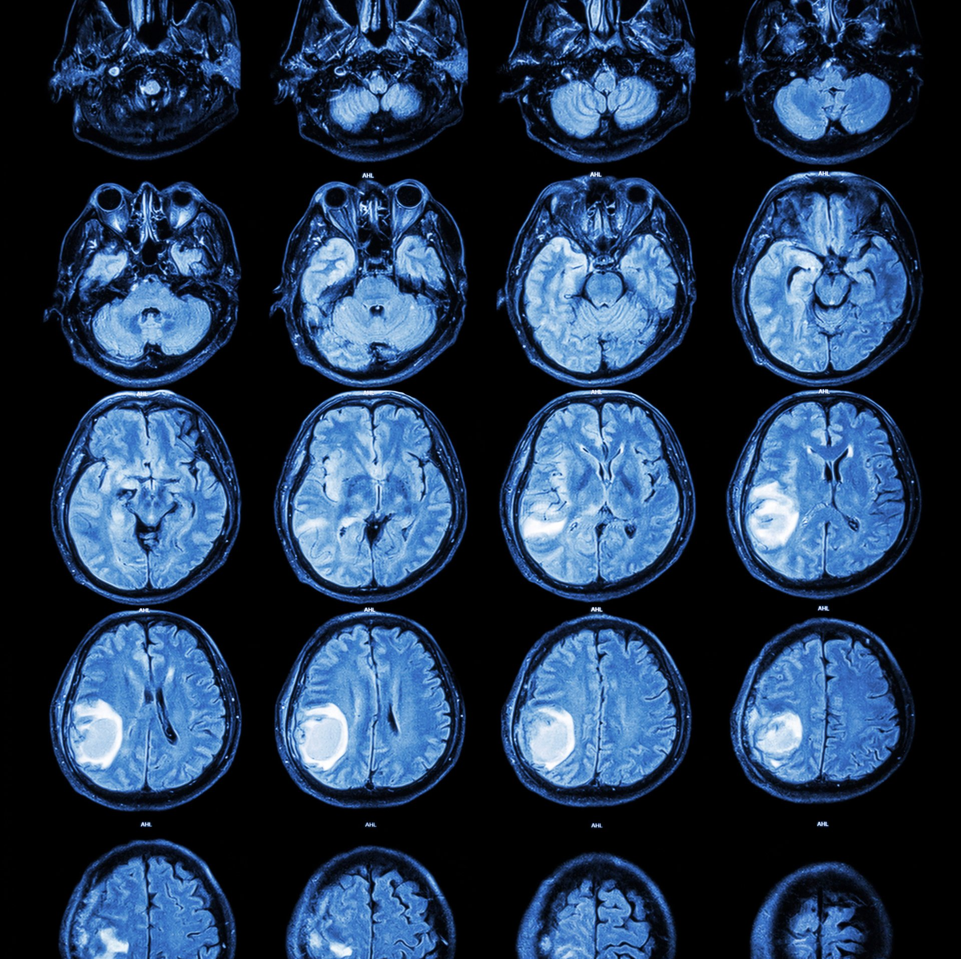 Tratar tumor cerebral na Barra da Tijuca Médico para tratar tumor cerebral na Barra da Tijuca