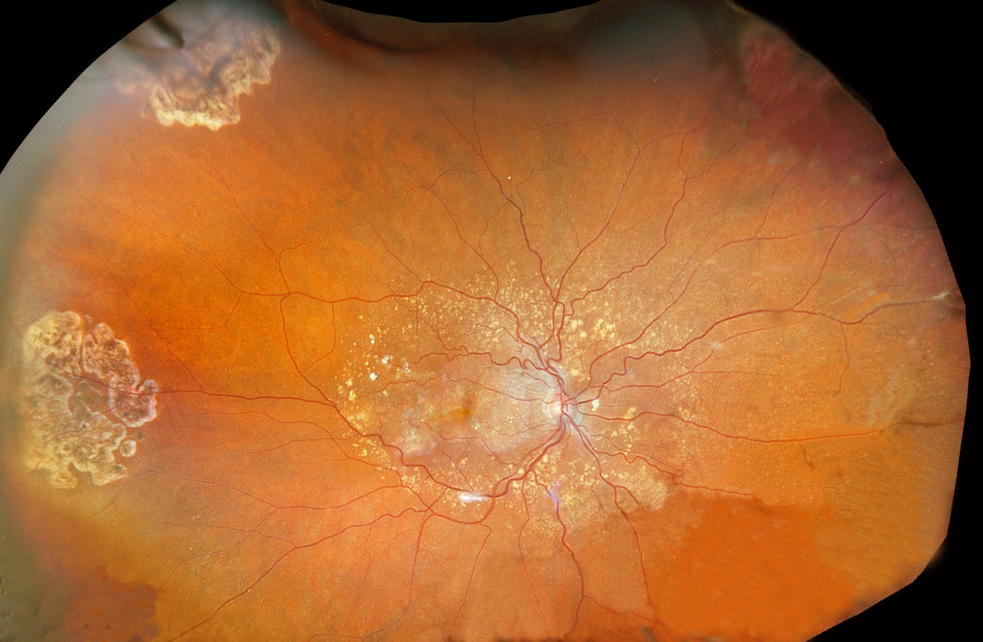 A close up of a person 's eye with a white spot on it.