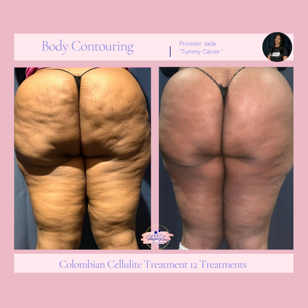 CELLULITE BEFORE AND AFTER