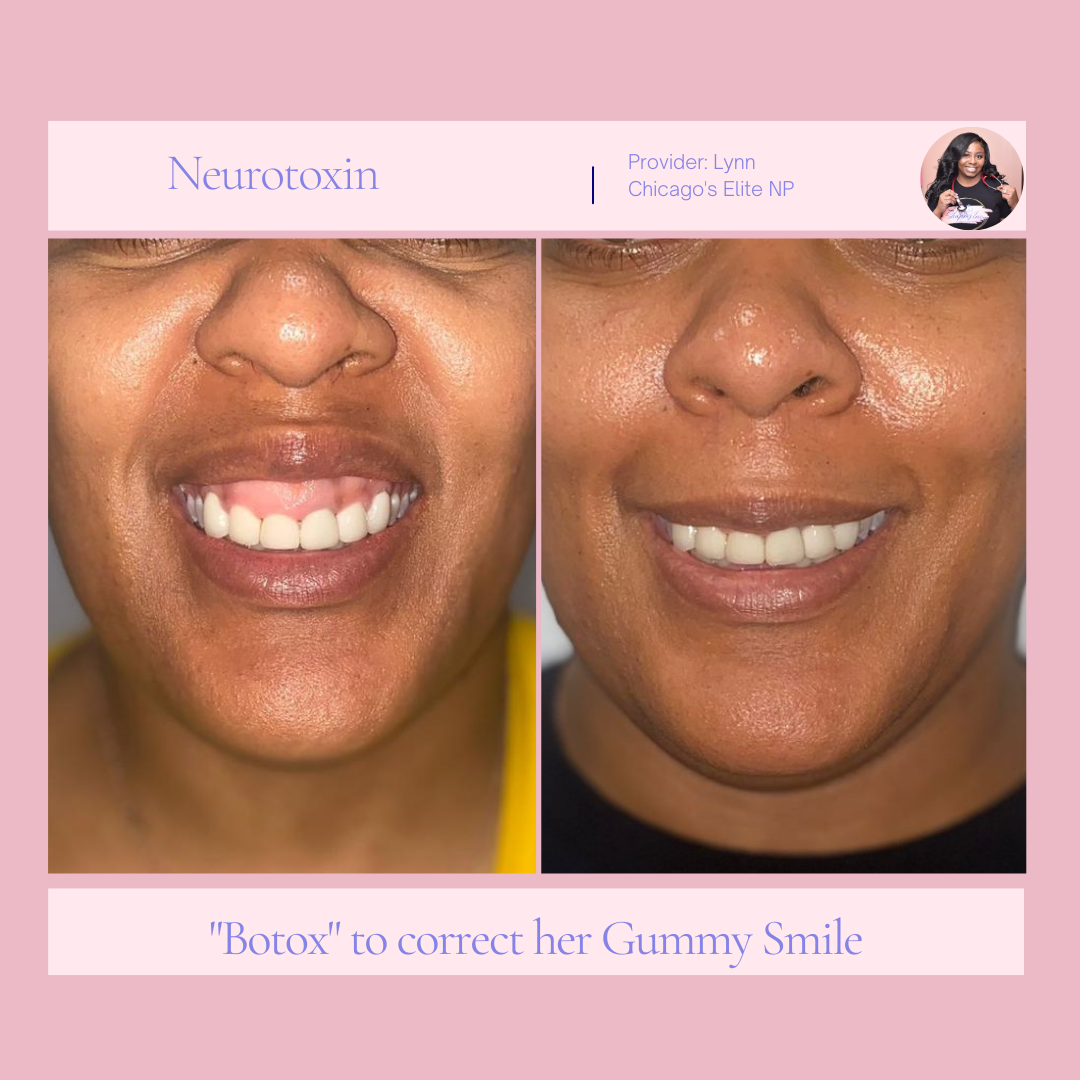 A before and after photo of a woman 's smile with botox.