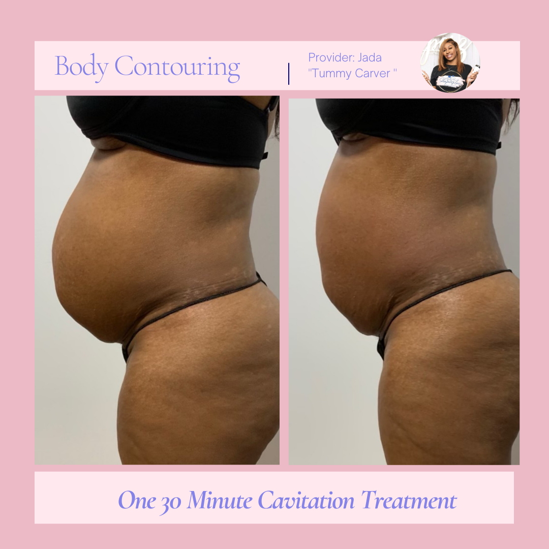 A woman 's stomach is shown before and after a body contouring treatment.