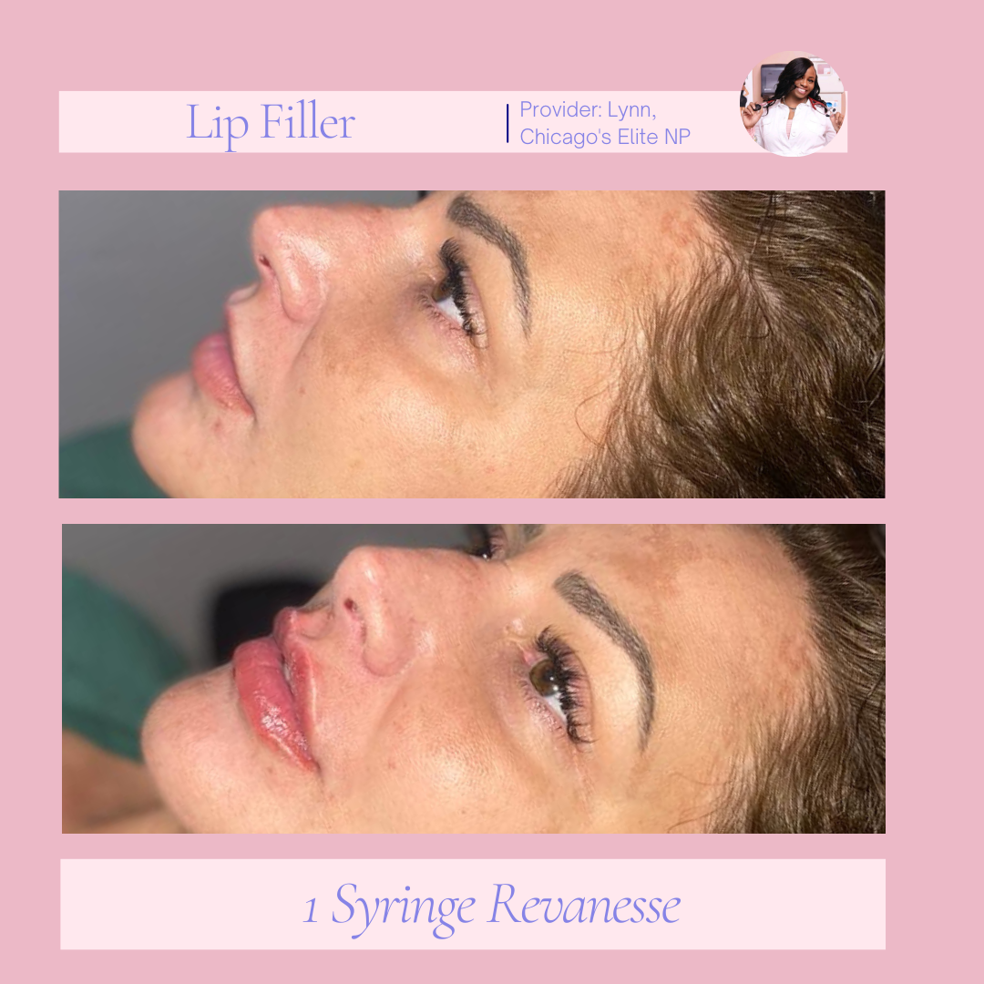 A before and after photo of a woman 's lips with a lip filler and a syringe.