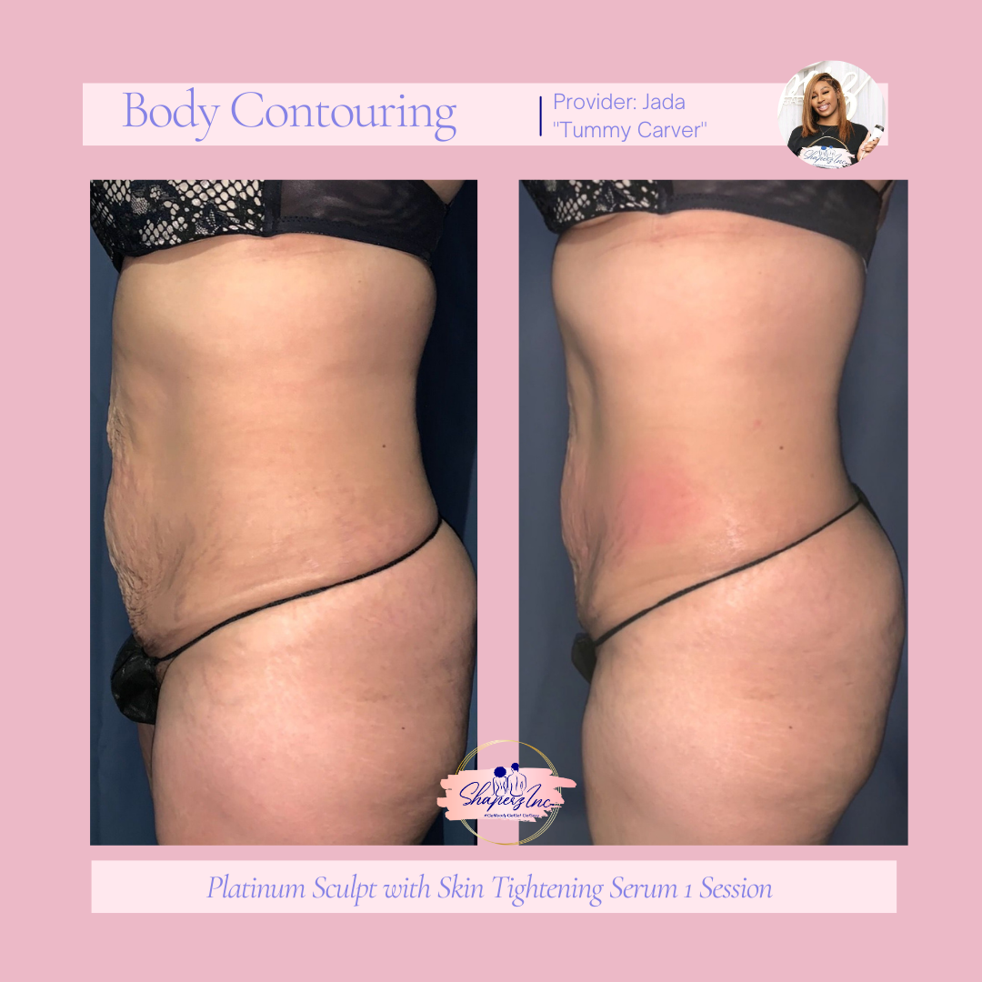 A woman 's stomach before and after a body contouring treatment.