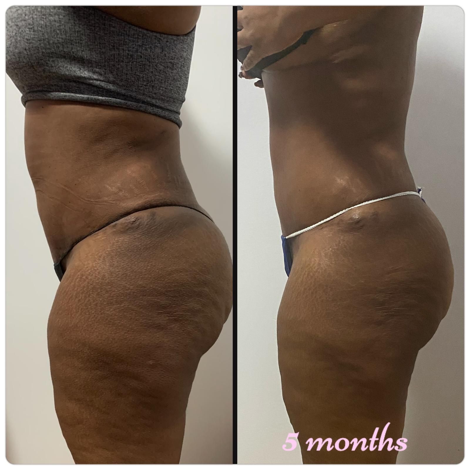 A before and after picture of a woman 's body with the words 5 months written on the bottom