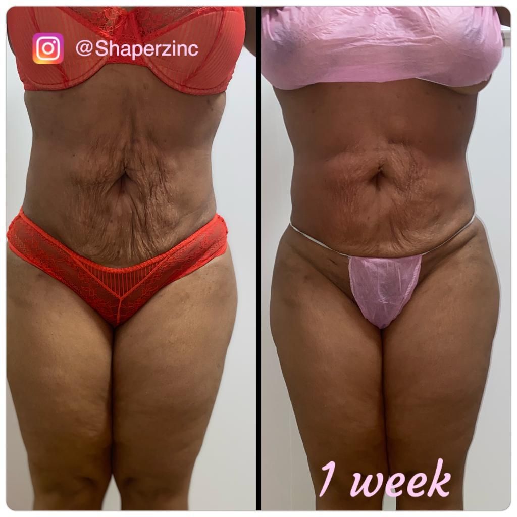 A before and after photo of a woman 's stomach.