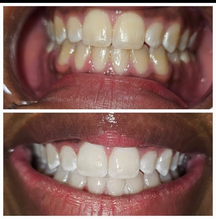 A before and after picture of a person 's teeth