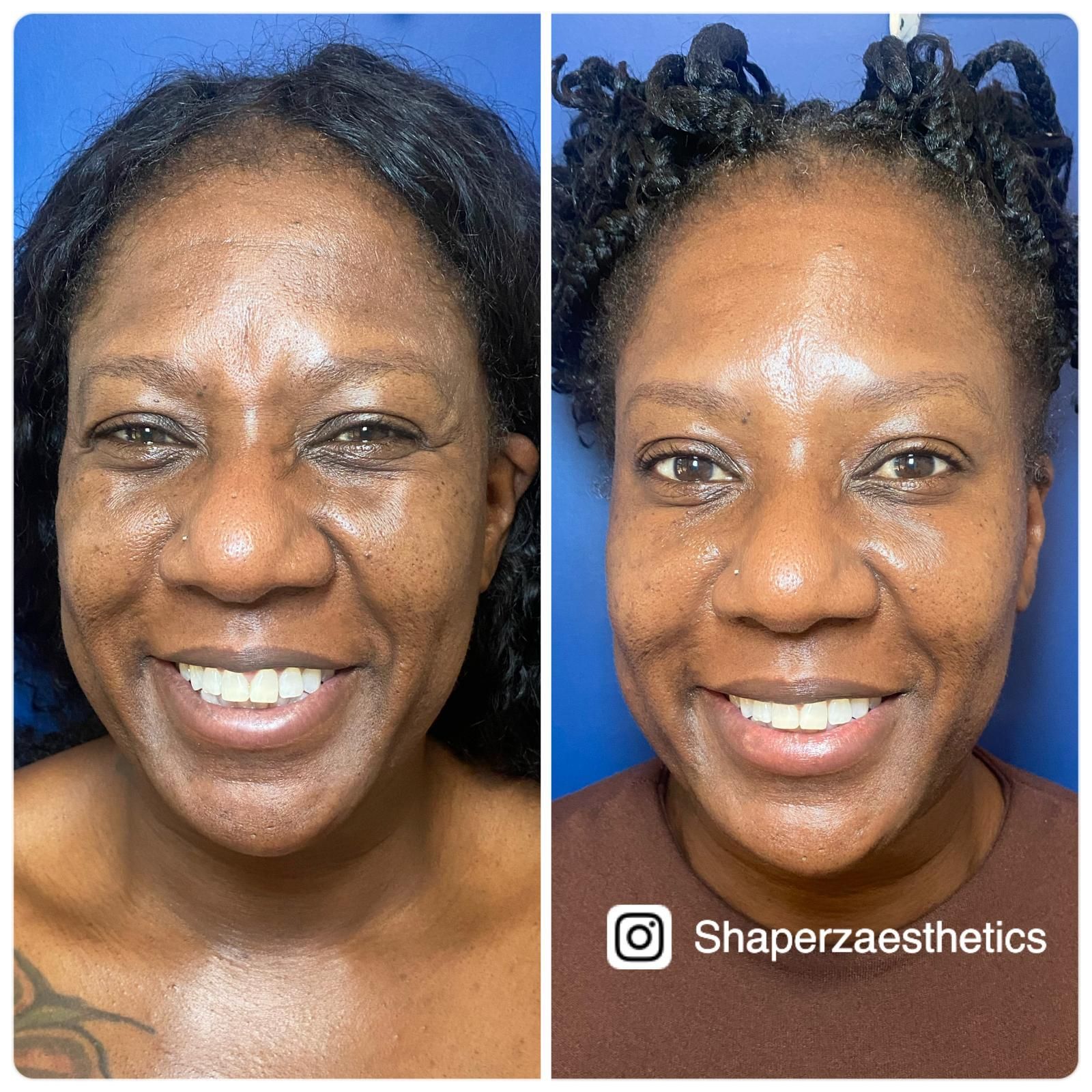 A before and after photo of a woman 's face by shaperzaesthetics