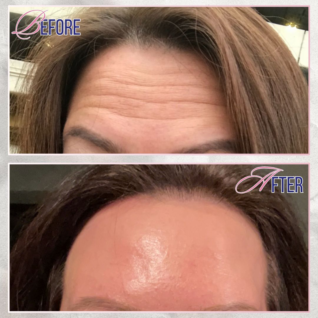A before and after photo of a woman 's forehead.