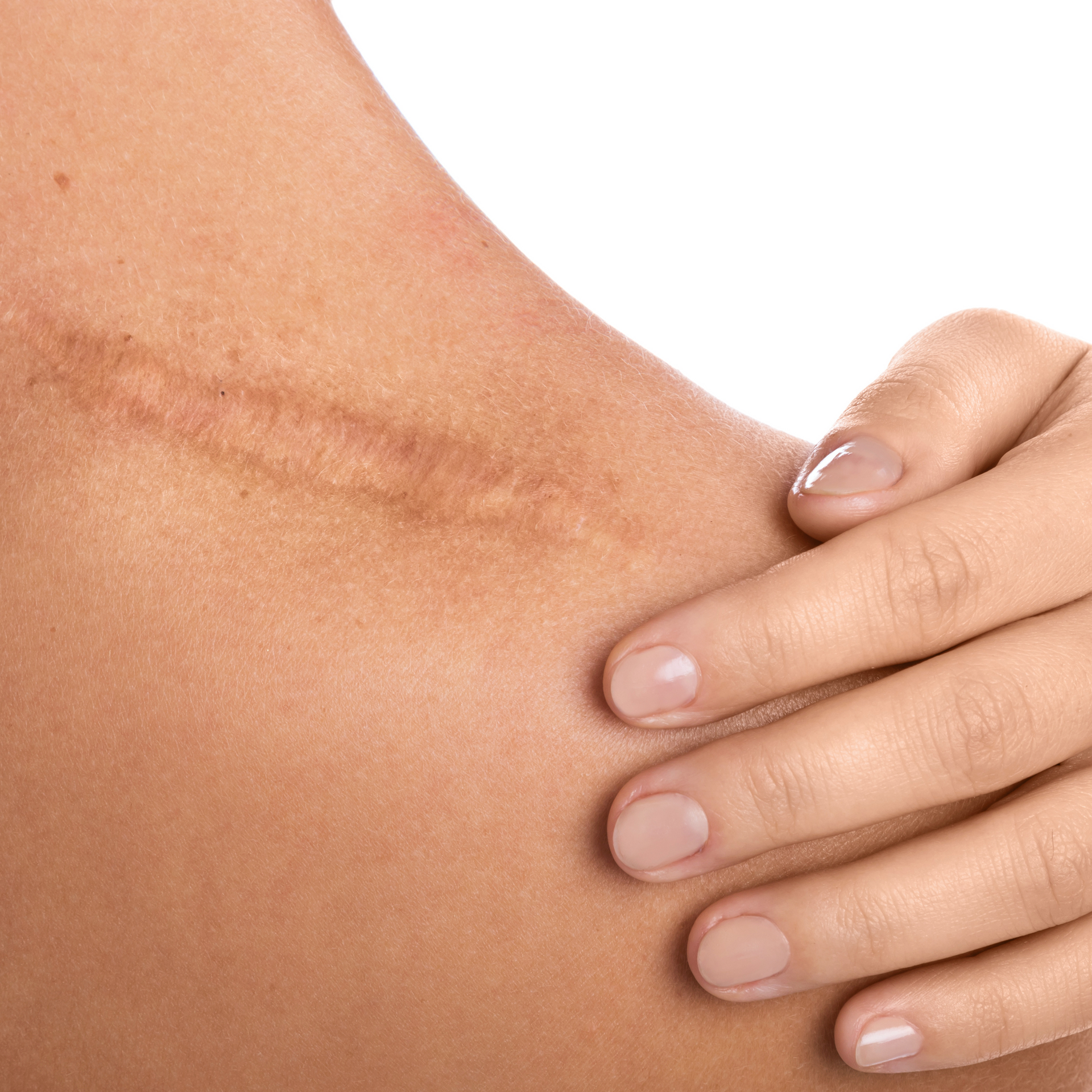 A woman 's hand is holding her shoulder with a scar on it.