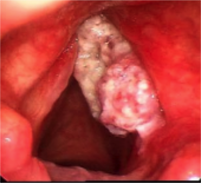 vocal cord cancer