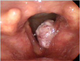 vocal cord cancer pre-op picture