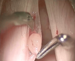 voicebox cyst removal