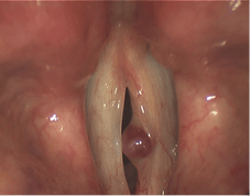 hemorrhagic polyp