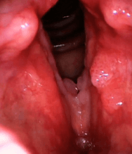 A close up of the inside of a person 's mouth