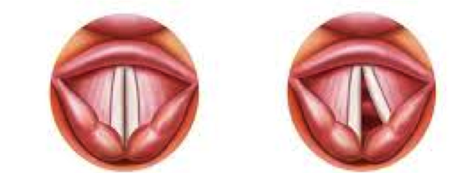 vocal cord paralysis