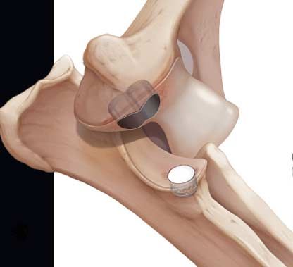 Anatomical knee illustration showing a meniscus tear with magnified circular inset.