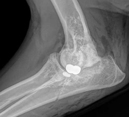 Side-view X-ray of a bent elbow with two metal implants visible inside the joint