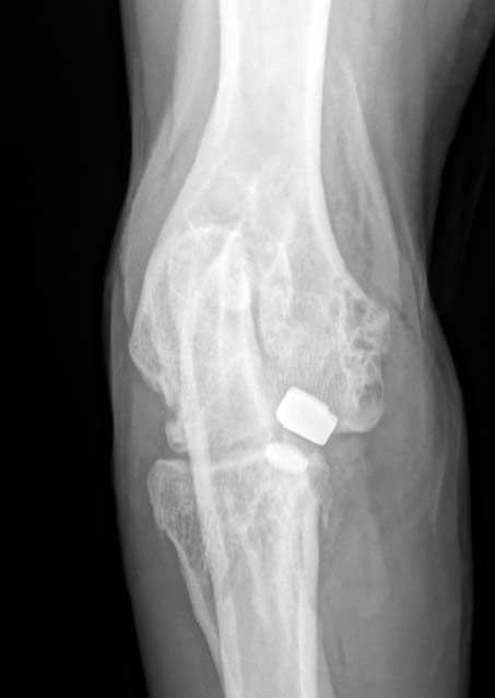 X-ray of an elbow joint with a small metallic implant or marker near the bone