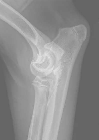 X-ray of a bent arm joint, showing the elbow in side view