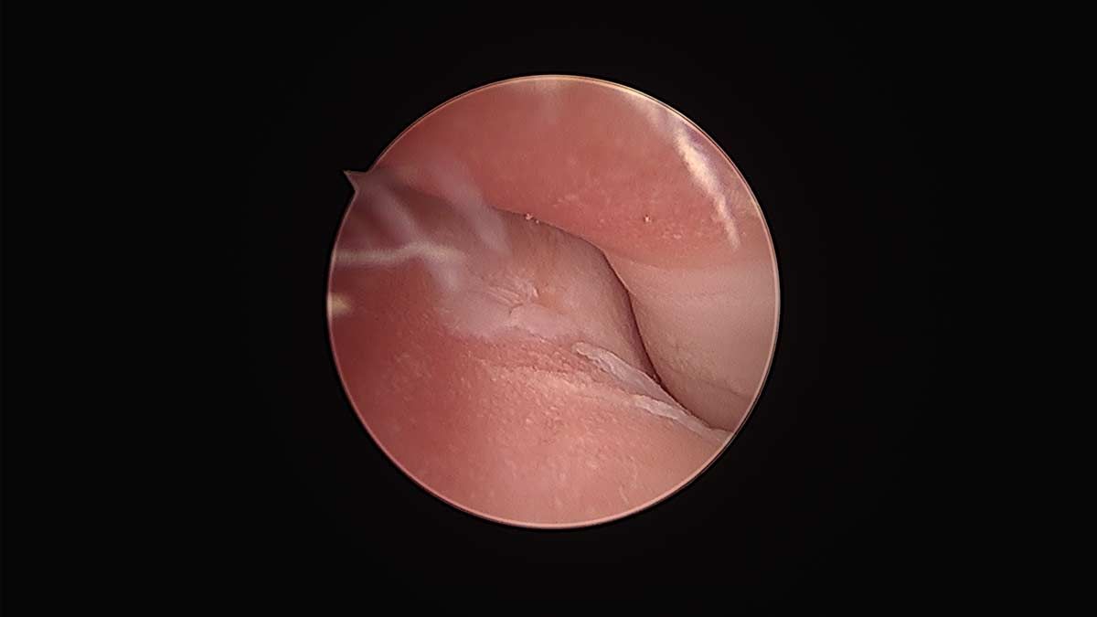 Close-up endoscopic view of pink tissue inside a body cavity against a black background