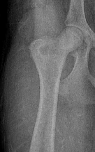 X-ray of a hip joint showing a fracture at the femoral neck