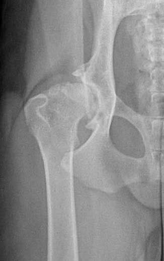 X-ray of a fractured hip joint with displaced femoral head and acetabular socket visible