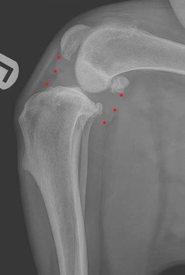 Lateral knee X-ray showing the joint and tibia in grayscale with red annotation dots.