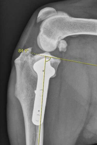 Lateral knee X-ray with a metal tibial implant and angle measurement overlay