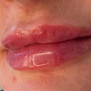 Aesthetics By Luisha | Lip Filler In Derby, UK