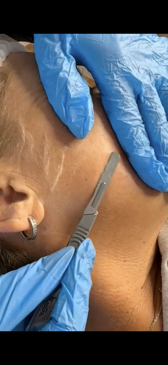 Aesthetics By Luisha | Dermaplaning In Derby, UK