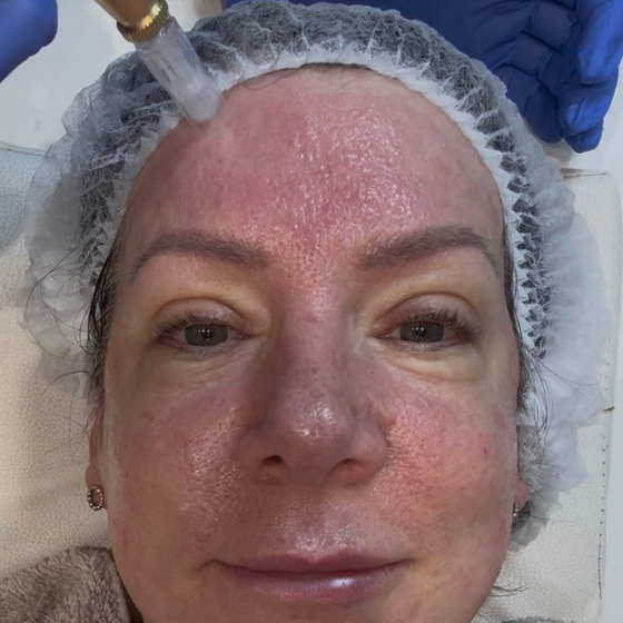 Aesthetics By Luisha | Microneedling In Derby, UK